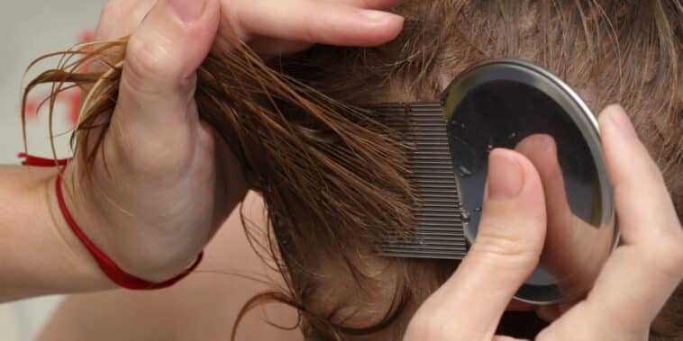 Astuces du quotidien : maîtrisez l'utilisation du bicarbonate de soude pour combattre les poux efficacement