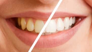 Comment nettoyer les dents jaunes : 5 conseils et méthodes pour retrouver un sourire éclatant