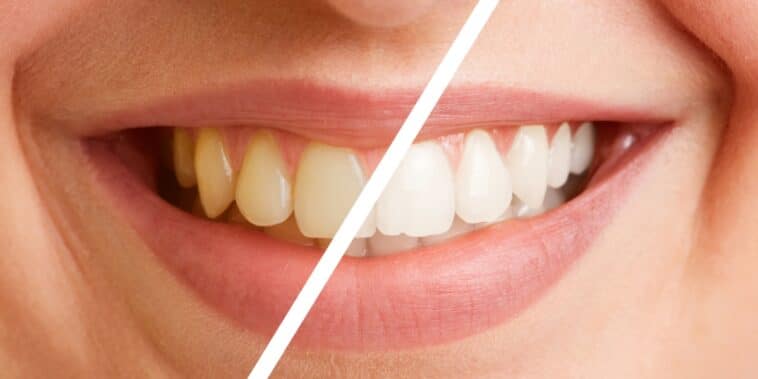 Comment nettoyer les dents jaunes : 5 conseils et méthodes pour retrouver un sourire éclatant