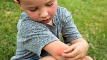 Comment calmer les piqûres de moustiques ? Quels sont les remèdes maison auxquels recourir à l’instant ?